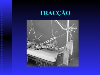 TRACÇÃO 