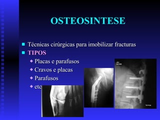 OSTEOSINTESE Técnicas cirúrgicas para imobilizar fracturas TIPOS Placas e parafusos Cravos e placas Parafusos etc. 