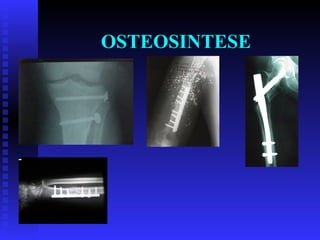 OSTEOSINTESE 
