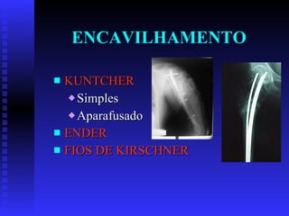 ENCAVILHAMENTO KUNTCHER Simples  Aparafusado ENDER FIOS DE KIRSCHNER 