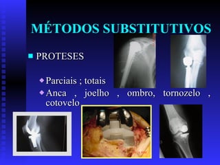 MÉTODOS SUBSTITUTIVOS PROTESES Parciais ; totais Anca , joelho , ombro, tornozelo , cotovelo 