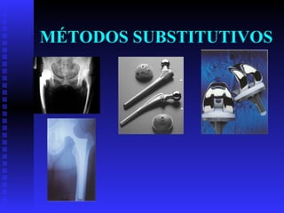 MÉTODOS SUBSTITUTIVOS 