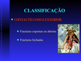 CLASSIFICAÇÃO CONTACTO COM O EXTERIOR Fracturas expostas ou abertas Fracturas fechadas 