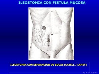 ILEOSTOMIA CON FISTULA MUCOSA ILEOSTOMIA CON SEPARACION DE BOCAS (CATELL / LAHEY)   Prof. Dr. Luis del Rio Diez 
