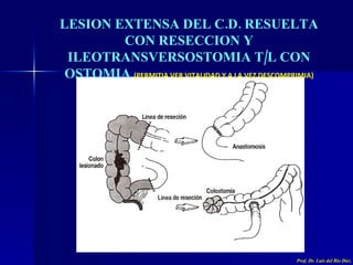 LESION EXTENSA DEL C.D. RESUELTA CON RESECCION Y ILEOTRANSVERSOSTOMIA T/L CON OSTOMIA   (PERMITIA VER VITALIDAD Y A LA VEZ...