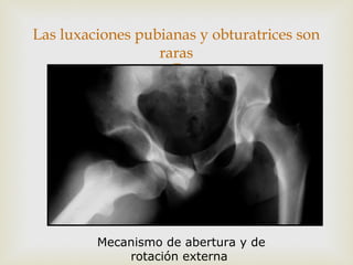 Las luxaciones pubianas y obturatrices son 
raras 
 
Mecanismo de abertura y de 
rotación externa 
 