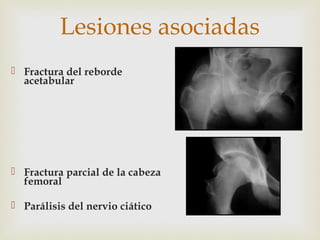 Lesiones asociadas 
 Fractura del reborde 
acetabular 
 Fractura parcial de la cabeza 
femoral 
 Parálisis del nervio ciático 
 