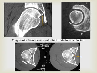Fragmento óseo incarcerado dentro de la articulación 
 
