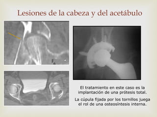 Lesiones de la cabeza y del acetábulo 
El tratamiento en este caso es la 
implantación de una prótesis total. 
La cúpula fijada por los tornillos juega 
el rol de una osteosíntesis interna. 
 