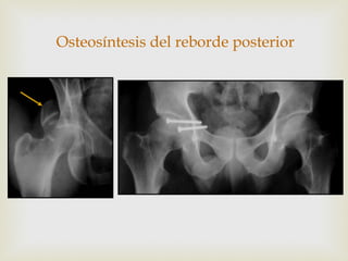 Osteosíntesis del reborde posterior 
 