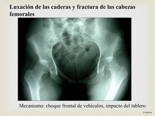 Luxación de las caderas y fractura de las cabezas 
femorales 
Mecanismo: choque frontal de vehículos, impacto del tablero 
D desme 
 