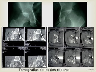 Tomografías de las dos caderas D desme 
 