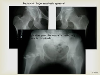 Reducción bajo anestesia general 
Luego clavijas percutáneas a la derecha y 
tornillos a la izquierda 
D desme 
 