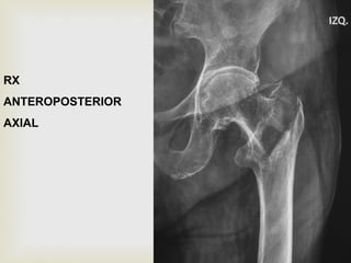 RX 
ANTEROPOSTERIOR 
AXIAL 
 