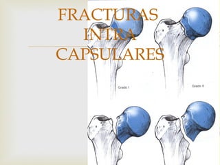 FRACTURAS 
INTRA 
 
CAPSULARES 
 