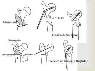 Tratamiento : 
 
Técnica de Sarmiento 
Técnica de Dimon y Hughston 
 