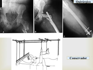  
Quirúrgico 
Conservador 
 