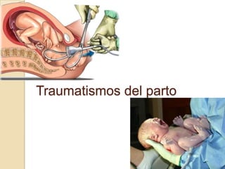 Traumatismos del parto
 