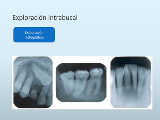 Exploración Intrabucal
Exploración
radiográfica
 