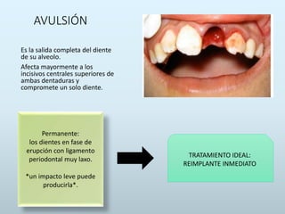 AVULSIÓN
Es la salida completa del diente
de su alveolo.
Afecta mayormente a los
incisivos centrales superiores de
ambas dentaduras y
compromete un solo diente.
Permanente:
los dientes en fase de
erupción con ligamento
periodontal muy laxo.
*un impacto leve puede
producirla*.
TRATAMIENTO IDEAL:
REIMPLANTE INMEDIATO
 