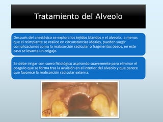Tratamiento del Alveolo
Después del anestésico se explora los tejidos blandos y el alveolo. a menos
que el reimplante se realice en circunstancias ideales, pueden surgir
complicaciones como la reabsorción radicular o fragmentos óseos, en este
caso se levanta un colgajo.
Se debe irrigar con suero fisiológico aspirando suavemente para eliminar el
coagulo que se forma tras la avulsión en el interior del alveolo y que parece
que favorece la reabsorción radicular externa.
 
