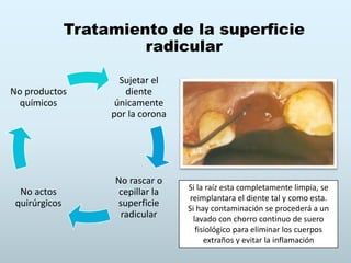 Tratamiento de la superficie
radicular
Sujetar el
diente
únicamente
por la corona
No rascar o
cepillar la
superficie
radicular
No actos
quirúrgicos
No productos
químicos
Si la raíz esta completamente limpia, se
reimplantara el diente tal y como esta.
Si hay contaminación se procederá a un
lavado con chorro continuo de suero
fisiológico para eliminar los cuerpos
extraños y evitar la inflamación
 