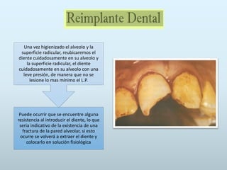Puede ocurrir que se encuentre alguna
resistencia al introducir el diente, lo que
seria indicativo de la existencia de una
fractura de la pared alveolar, si esto
ocurre se volverá a extraer el diente y
colocarlo en solución fisiológica
Una vez higienizado el alveolo y la
superficie radicular, reubicaremos el
diente cuidadosamente en su alveolo y
la superficie radicular, el diente
cuidadosamente en su alveolo con una
leve presión, de manera que no se
lesione lo mas mínimo el L.P.
 