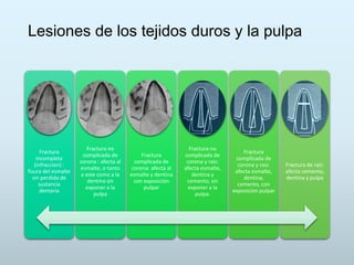 Lesiones de los tejidos duros y la pulpa
Fractura
incompleta
(infraccion) :
fisura del esmalte
sin perdida de
sustancia
dentaria
Fractura no
complicada de
corona : afecta al
esmalte, o tanto
a este como a la
dentina sin
exponer a la
pulpa
Fractura
complicada de
corona: afecta al
esmalte y dentina
con exposición
pulpar
Fractura no
complicada de
corona y raíz:
afecta esmalte,
dentina y
cemento, sin
exponer a la
pulpa.
Fractura
complicada de
corona y raíz:
afecta esmalte,
dentina,
cemento, con
exposición pulpar
Fractura de raíz:
afecta cemento,
dentina y pulpa
 
