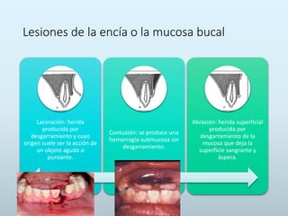 Lesiones de la encía o la mucosa bucal
Laceración: herida
producida por
desgarramiento y cuyo
origen suele ser la acción de
un objeto agudo o
punzante.
Contusión: se produce una
hemorragia submucosa sin
desgarramiento.
Abrasión: herida superficial
producida por
desgarramiento de la
mucosa que deja la
superficie sangrante y
áspera.
 