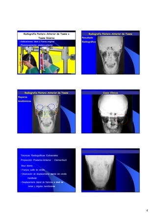Radiografía Postero-Anterior de Towne o                Radiografía Póstero-Anterior de Towne
                       Towne Inversa                   Resultado
  Indicaciones: ídem a Towne original                  Radiográfico
  Posicionamiento: póstero-anterior




      Radiografia Póstero-Anterior de Towne                             Casos Clínicos
Reparos
Anatómicos




  Técnicas Radiográficas Extraorales

  Proyección Posterior-Anterior : Clementisch

  Boca Abierta
  • Fractura cuello de cóndilo
  • Observación de desplazamiento medial del cóndilo
          mandibular
  • Desplazamiento lateral de fracturas a nivel de
          ramas y ángulos mandibulares




                                                                                                    4
 