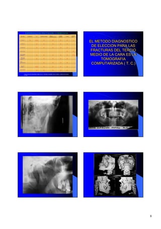 RADIOGRAFIAS PARA FRACTURAS DEL 1/3 MEDIO FACIAL
                                                             AXIAL O             LATERAL                LATEARAL
 FRACTURA         PANORAMICA     TAC       POSTEROANTERIOR                                    WATERS
                                                             SUBMENTOVERTEX      CRANEO-                NASAL




 LE FORT I *
                     +          +/-              +                 +               +            +          -       EL METODO DIAGNOSTICO
                                                                                                                   EL METODO DIAGNOSTICO
LE FORT II *
                                  +              +                 +               +            +
                                                                                                                     DE ELECCION PARA LAS
                                                                                                                    DE ELECCION PARA LAS
LE FORT III *
                                  +              +                 +               +            +
SOLO NASAL
                                                                                                +         +
                                                                                                                    FRACTURAS DEL TERCIO
                                                                                                                    FRACTURAS DEL TERCIO
NASO ORBITO
ETMOIDAL *                        +              +                 +               +            +        +/-        MEDIO DE LA CARA ES LA
                                                                                                                   MEDIO DE LA CARA ES LA
 ORBITARIA
 CON BLOW
 OUT *                            +              +                 +               +            +                        TOMOGRAFIA
                                                                                                                         TOMOGRAFIA
                                                                                                                    COMPUTARIZADA ( T. C.)
ARCO
ZOGOMATICO
*                                                +                 +               +            +                   COMPUTARIZADA ( T. C.)
 MALAR Y
 ARCO *                         +/-              +                 +               +            +
BASE CRANEO
*                                 +              +                 +               +            +
         * FRACTURAS QUE REQUIEREN SERIE FACIAL : POSTERO ANTERIOR, AXIAL O SUBM., LATERAL DE CRANEO,
         WATERS




                                                                                                                                             8
 