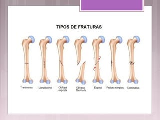 TIPOS DE FRATURAS
 