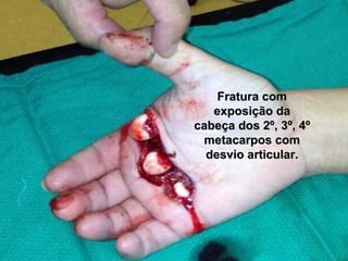 Fratura comFratura com
exposição daexposição da
cabeça dos 2º, 3º, 4ºcabeça dos 2º, 3º, 4º
metacarpos commetacarpos com
desvio articular.desvio articular.
 