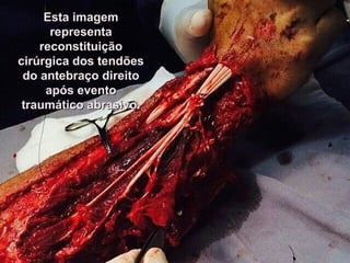 Esta imagemEsta imagem
representarepresenta
reconstituiçãoreconstituição
cirúrgica dos tendõescirúrgica dos tendões
do antebraço direitodo antebraço direito
após eventoapós evento
traumático abrasivo.traumático abrasivo.
 