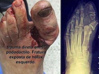 trauma direto em 1ºtrauma direto em 1º
pododáctilo. Fraturapododáctilo. Fratura
exposta de háluxexposta de hálux
esquerdo.esquerdo. 
 