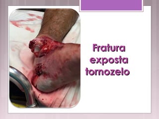 FraturaFratura
expostaexposta
tornozelo tornozelo 
 