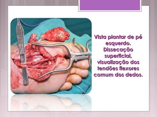 Vista plantar de péVista plantar de pé
esquerdo.esquerdo.
DissecaçãoDissecação
superficial,superficial,
visualização dosvisualização dos
tendões flexorestendões flexores
comum dos dedos.comum dos dedos.
 