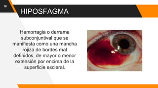 HIPOSFAGMA
Hemorragia o derrame
subconjuntival que se
manifiesta como una mancha
rojiza de bordes mal
definidos, de mayor o menor
extensión por encima de la
superficie escleral.
16
 