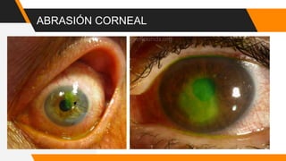 ABRASIÓN CORNEAL
 