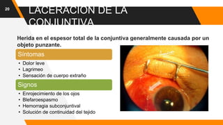 LACERACIÓN DE LA
CONJUNTIVA
Herida en el espesor total de la conjuntiva generalmente causada por un
objeto punzante.
20
Síntomas
• Dolor leve
• Lagrimeo
• Sensación de cuerpo extraño
Signos
• Enrojecimiento de los ojos
• Blefaroespasmo
• Hemorragia subconjuntival
• Solución de continuidad del tejido
 