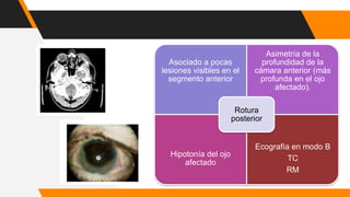 Asociado a pocas
lesiones visibles en el
segmento anterior
Asimetría de la
profundidad de la
cámara anterior (más
profunda en el ojo
afectado).
Hipotonía del ojo
afectado
Ecografía en modo B
TC
RM
Rotura
posterior
 