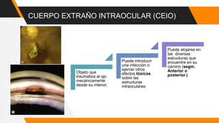 CUERPO EXTRAÑO INTRAOCULAR (CEIO)
Objeto que
traumatiza al ojo
mecánicamente
desde su interior.
Puede introducir
una infección o
ejercer otros
efectos tóxicos
sobre las
estructuras
intraoculares.
Puede alojarse en
las diversas
estructuras que
encuentre en su
camino (segm.
Anterior o
posterior.)
 
