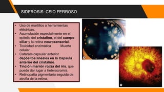 SIDEROSIS: CEIO FERROSO
• Uso de martillos o herramientas
eléctricas.
• Acumulación especialmente en el
epitelio del cristalino, el del cuerpo
ciliar y la retina neurosensorial.
• Toxicidad enzimática Muerte
celular
• Catarata capsular anterior
depósitos lineales en la Capsula
anterior del cristalino.
• Tinción marrón rojiza del iris, que
puede dar lugar a heterocromía.
• Retinopatía pigmentaria seguida de
atrofia de la retina.
 