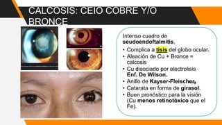 CALCOSIS: CEIO COBRE Y/O
BRONCE
Intenso cuadro de
seudoendoftalmitis.
• Complica a tisis del globo ocular.
• Aleación de Cu + Bronce =
calcosis
• Cu disociado por electrolisis
Enf. De Wilson.
• Anillo de Kayser-Fleischer.
• Catarata en forma de girasol.
• Buen pronóstico para la visión
(Cu menos retinotóxico que el
Fe).
 