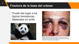 Fractura de la base del cráneo
▸ Puede dar lugar a los
típicos hematomas
bilaterales en anillo
5
 