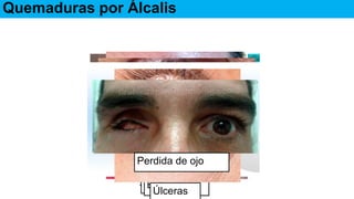 Complicaciones:
Quemaduras por Álcalis
SimblefarónEctropiónEntropión
Úlceras
Perdida de ojo
 