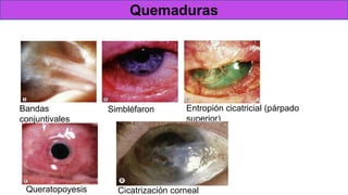 Complicaciones
Bandas
conjuntivales
Simbléfaron Entropión cicatricial (párpado
superior)
Queratopoyesis Cicatrización corneal
Quemaduras
 