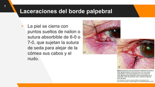▸ La piel se cierra con
puntos sueltos de nailon o
sutura absorbible de 6-0 o
7-0, que sujetan la sutura
de seda para alejar de la
córnea sus cabos y el
nudo.
7
Laceraciones del borde palpebral
 