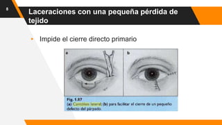 ▸ Impide el cierre directo primario
8
Laceraciones con una pequeña pérdida de
tejido
 