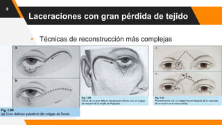 Laceraciones con gran pérdida de tejido
▸ Técnicas de reconstrucción más complejas
9
 